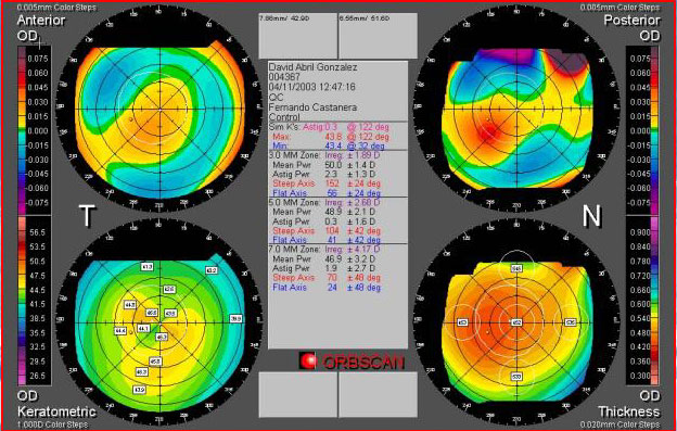 Topografia-Queratocono